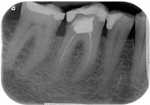 Digital X Rays