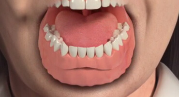 Multiple Teeth